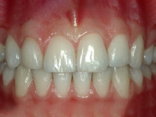 missing lateral incisors after