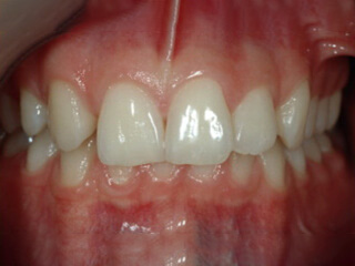 missing lateral incisors before